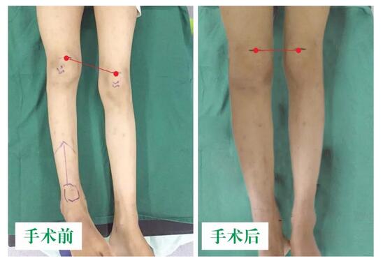 女孩墜梯右腿縮短5cm，幸得醫(yī)生及時診治恢復(fù)正常腿型