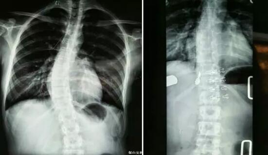 好好的脊柱怎么說彎就彎了？你竟然都沒發(fā)現(xiàn)……