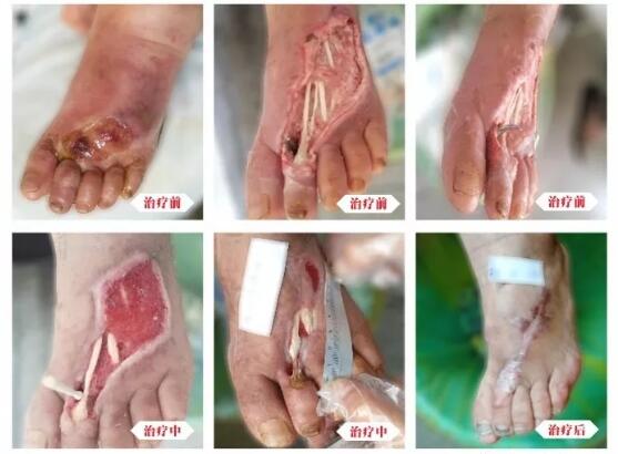 糖尿病并發(fā)癥有多可怕，及時(shí)治療糖尿病足避免截肢！