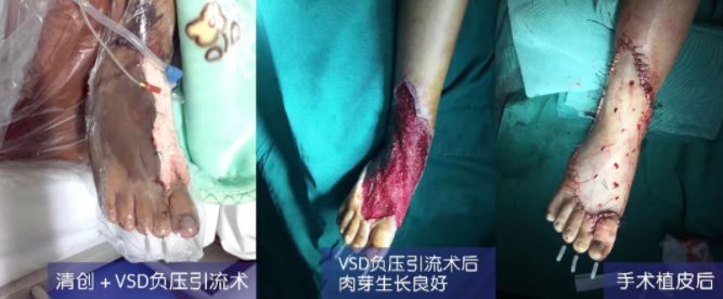 車禍猛如虎，救治如“華佗” ，手術(shù)＋康復(fù)，8歲小女孩車禍后日漸康復(fù)行走