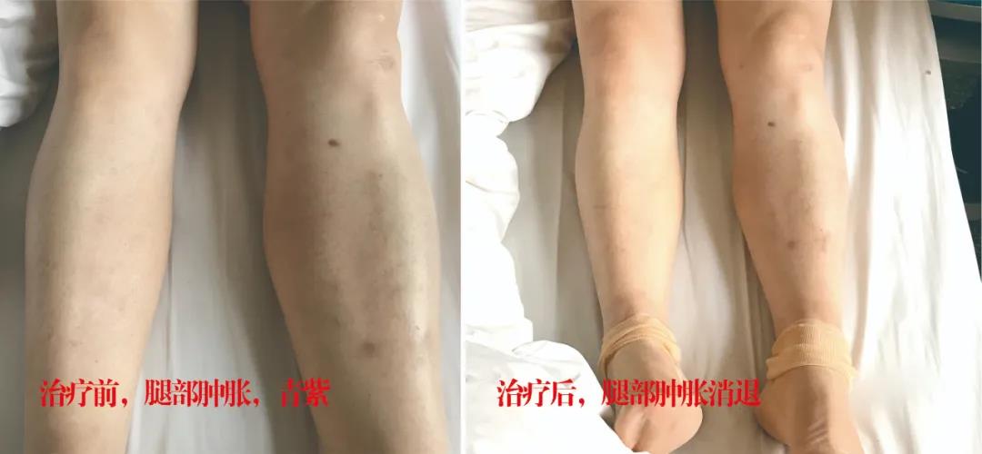 下肢靜脈血栓多年頑疾反復腫痛——疾病不容等待，早治療，早健康！