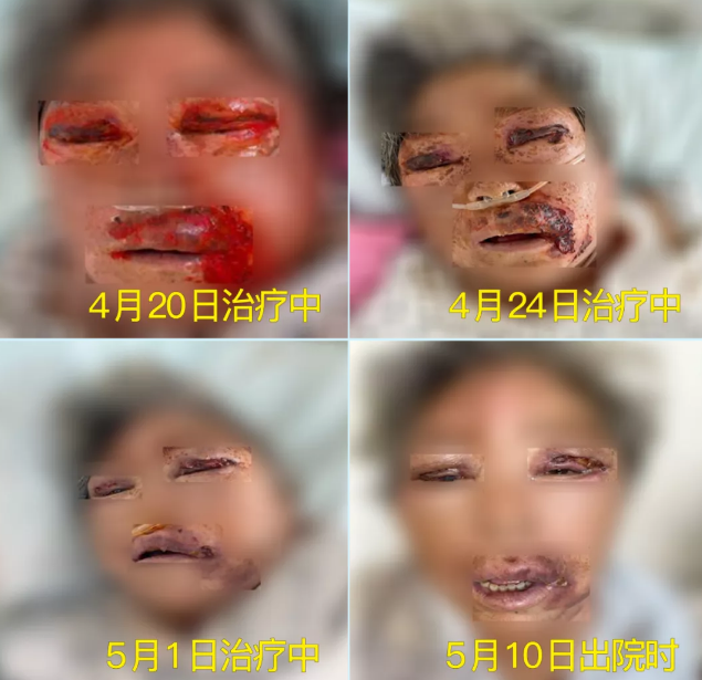 膿毒血癥（急性頜面部蜂窩組織炎）多學科聯(lián)合會診，幫助患者成功治愈！