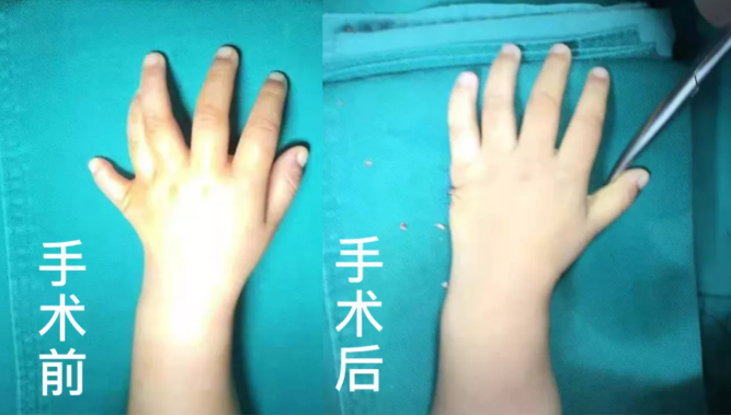 【保山安利醫(yī)院】2歲小兒手、足多指（趾）成功修復(矯正）！