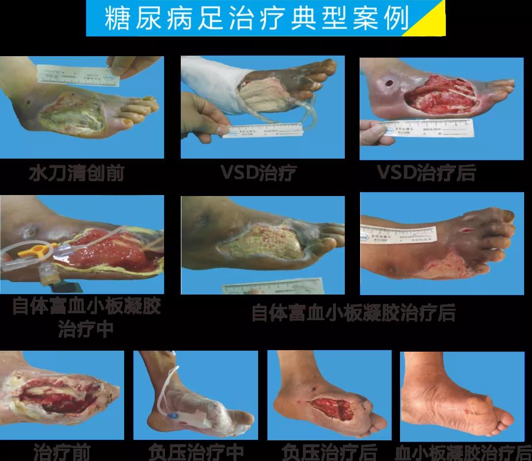截肢、失明，甚至……，我們要做的是將糖尿病并發(fā)癥遏制在搖籃里！