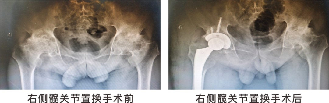 【保山安利醫(yī)院】長期飲酒導致雙側(cè)股骨頭壞死，髖關節(jié)置換后重獲運動功能！