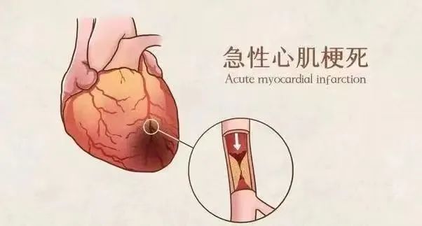 【保山安利醫(yī)院】11月20日“心梗救治日” 時(shí)間就是心肌，時(shí)間就是生命！